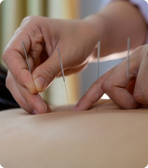 Traitement d'acupuncture — mains et aiguilles